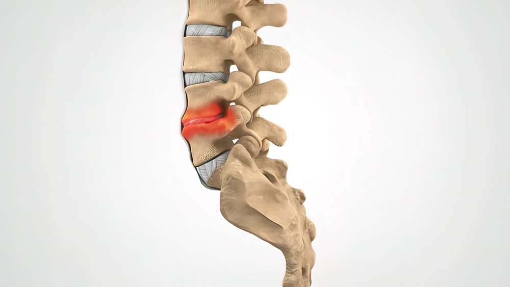 Pillow of Degenerative disc disease, 3D CT scan